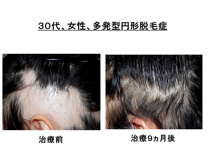 円形脱毛症　病院